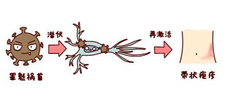 什么是带状疱疹神经痛？为什么会“痛不欲生”？